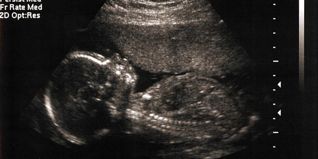 Five-month-old fetus in womb as imaged by sonogram/ultrasound.