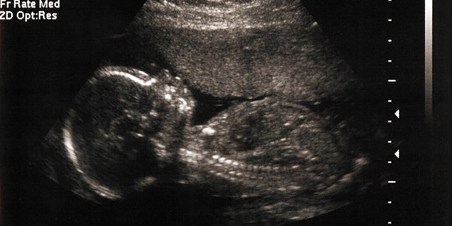 A 5-month fetus in the womb as imaged by sonogram / ultrasound