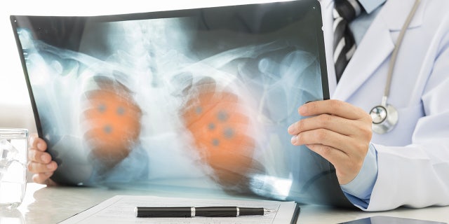 The most deaths from cancer in 2022 were due to lung cancer.