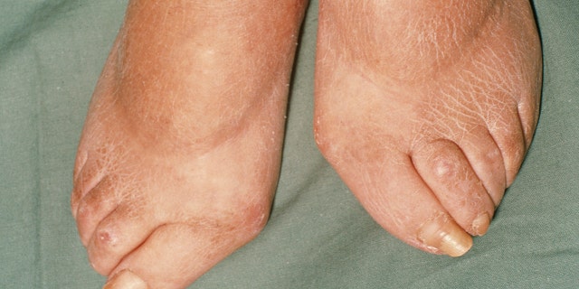 Scleroderma