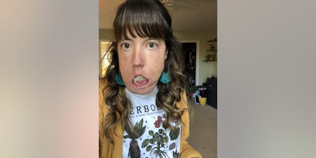 Hannah Setzer was born with a rare disorder survived at least 60 reconstructive surgeries to now become a passionate fitness instructor. Courtesy of Hannah Setzer.