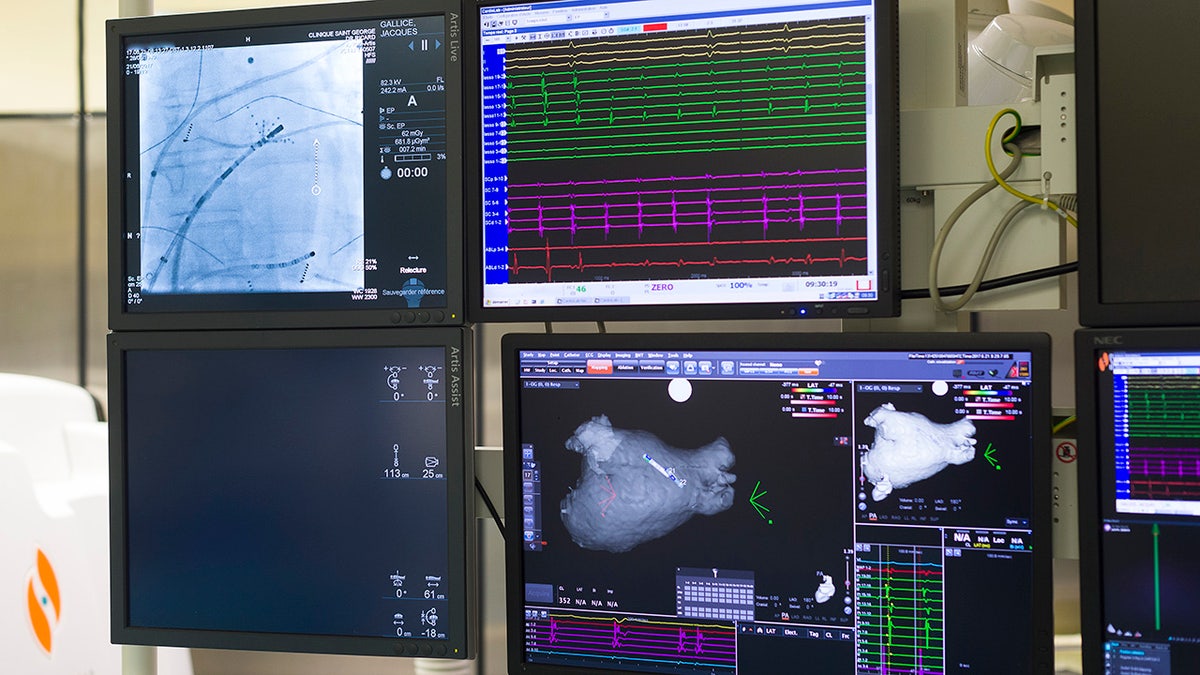 Radiofrequency ablation of cardiac arrhythmia using the Stereotaxis robotic system, by inserting a catheter into the heart, emitting radio waves that will cauterize cardiac tissue responsible for rhythmic irregularity. (Photo by: BSIP/Universal Images Group via Getty Images)