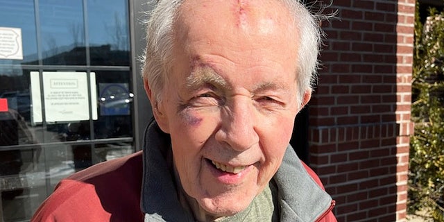 Another view of Marine veteran Ed Norton, with the facial bruises and cuts from his fall.  He believes the masks that so many Americans have had to wear have been 