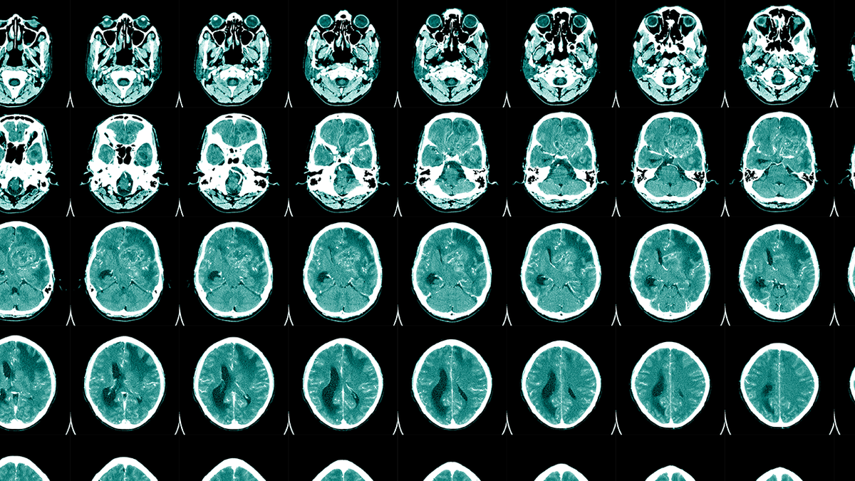 Brain scans istock