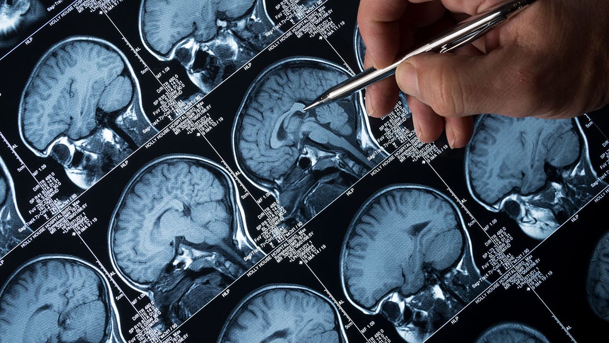 MRI Brain Scan of head and skull with hand pointing