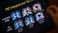 Alzheimer's disease impacting 6.5M older Americans