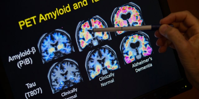 In this May 19, 2015, file photo, a doctor points to PET scan results that are part of a study on Alzheimer's disease at a hospital in Washington. Scientists know that long before the memory problems of Alzheimer's become obvious, people experience more subtle changes in their thinking and judgment. 