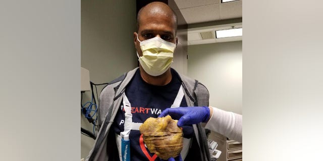Donald Crigler is pictured with his old heart — the one he was born with. 