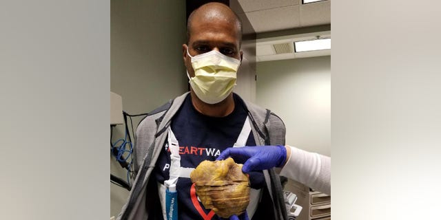Donald Crigler is pictured with his old heart — the one he was born with.