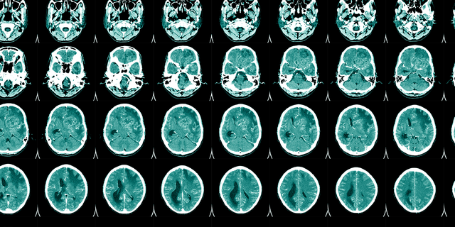 What is aphasia? | Fox News