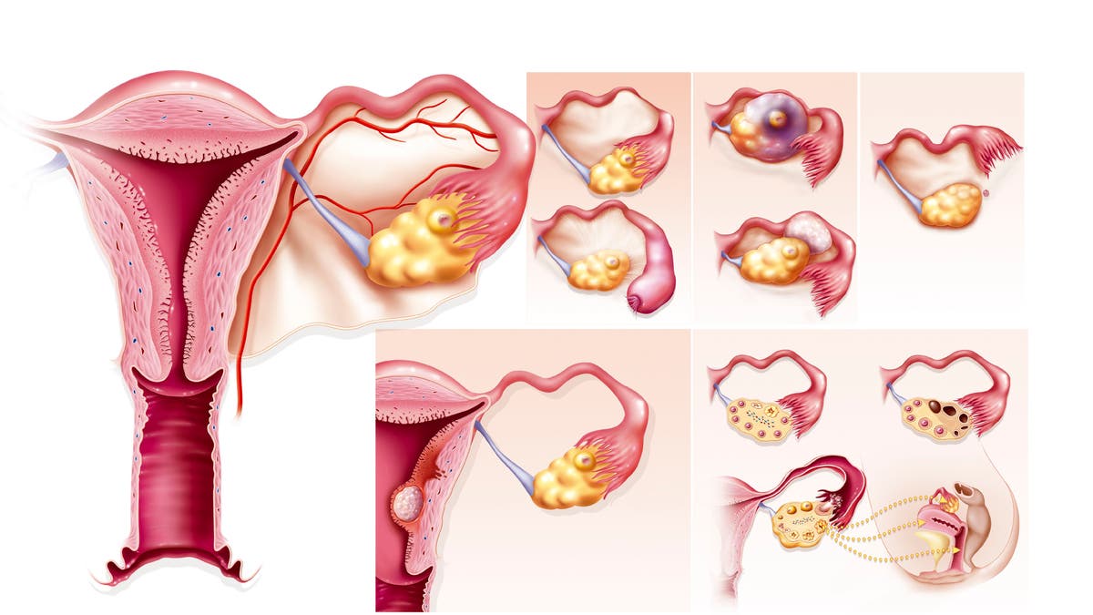 Illustration of polycystic ovary syndrome (PCOS)