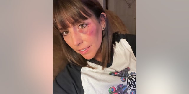 Moore posted a picture of the black eye on Facebook