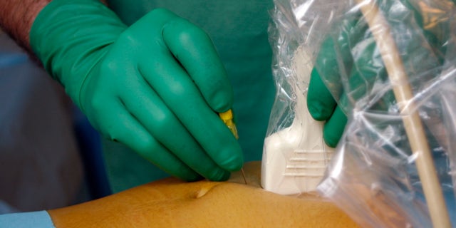 Amniocentesis on a woman who is 20 weeks pregnant. A sample of amniotic fluid is taken from the uterus. The fluid and fetal tissue contained in it will be examined allowing any potential chromosomal or enzyme abnormalities, responsible for hereditary illness and malformation, to be detected.