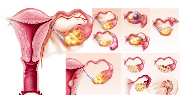 An illustration of the causes of female infertility. Top right, an illustration of various Fallopian tube pathologies. Below that, an illustration of various pathologies of the uterus. Also, an illustration of pathologies of the ovaries: ovulatory insufficiency, polycystic ovaries, luteal insufficiency. (Photo: BSIP/Universal Images Group via Getty Images)