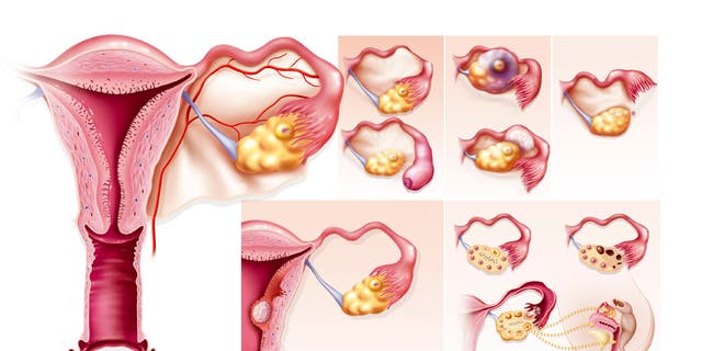 An illustration of the causes of female infertility. Top right, an illustration of various Fallopian tube pathologies. Below that, an illustration of various pathologies of the uterus. Also, an illustration of pathologies of the ovaries: ovulatory insufficiency, polycystic ovaries, luteal insufficiency. (Photo: BSIP/Universal Images Group via Getty Images)