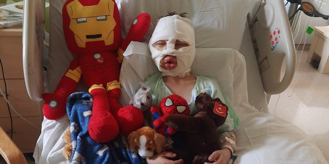 Dominick Krankall, 6, has a swollen face and has a long recovery, but might eventually have minimal scarring as a result of the incident.