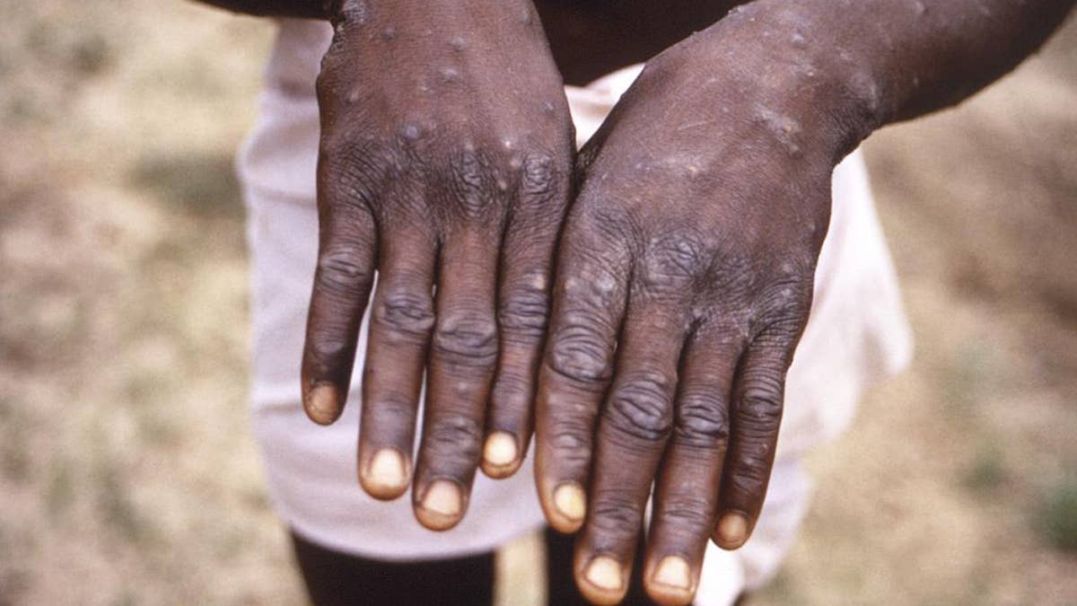 Monkeypox virus on hands