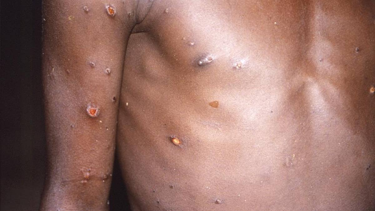 Man's chest with monkeypox virus