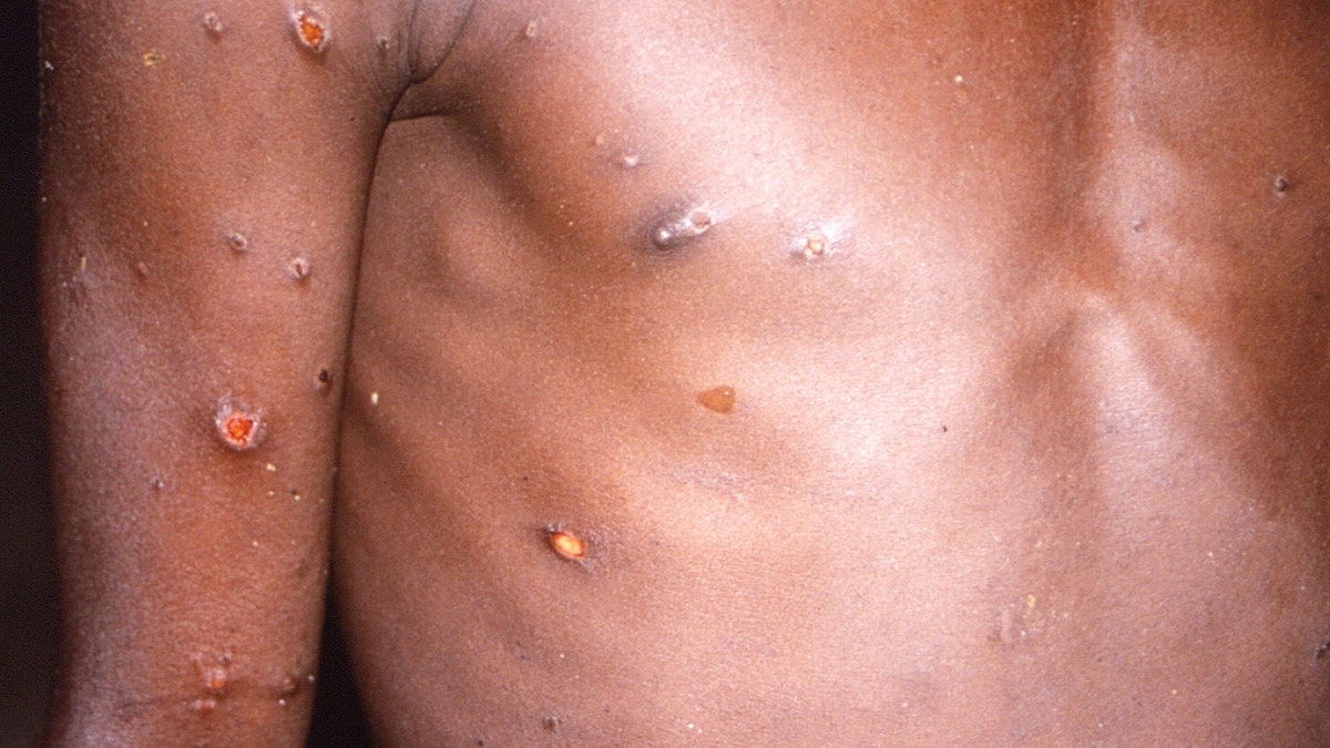 The torso of a patient with monkeypox