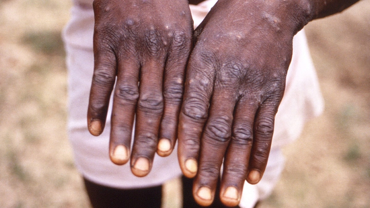 The hands of a patient infected with monkeypox virus