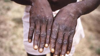 Monkeypox presents moderate risk to global public health, WHO says
