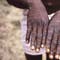 Monkeypox presents moderate risk to global public health, WHO says