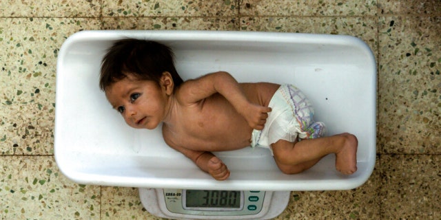 A malnourished baby is weighed at the Indira Gandhi hospital in Kabul, Afghanistan, Sunday, May 22, 2022. Some 1.1 million Afghan children under the age of five will face malnutrition by the end of the year, as hospitals wards are already packed with sick children.