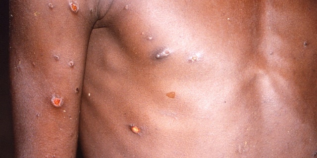 An image of a patient with skin lesions due to monkeypox in an undated image obtained by Reuters May 18, 2022. 