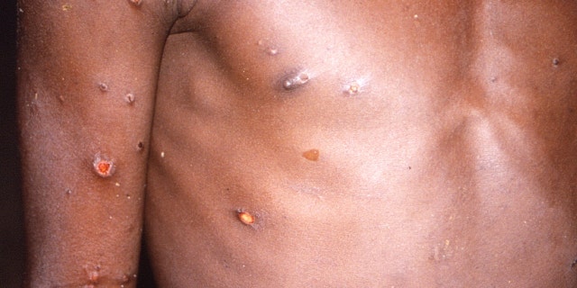 An image of a patient with skin lesions due to monkeypox in an undated image obtained by Reuters May 18, 2022. 