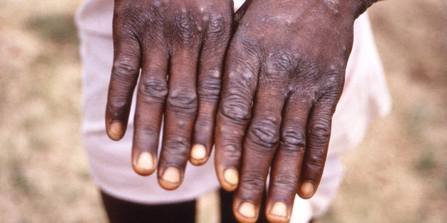 Images produced during the 1996-1997 investigation of monkeypox outbreaks in the Democratic Republic of the Congo (DRC) show the hands of patients with a monkeypox rash. This dateless image was taken by Reuters.  May 18, 2022. 