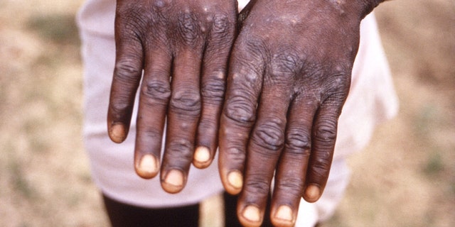 Een afbeelding gemaakt tijdens een onderzoek naar een uitbraak van apenpokken, die plaatsvond in de Democratische Republiek Congo (DRC), 1996 tot 1997, toont de handen van een patiënt met uitslag als gevolg van apenpokken, in deze ongedateerde afbeelding verkregen door Reuters op 18 mei 2022. 