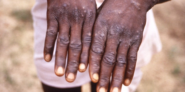 An image created during an investigation into an outbreak of monkeypox in the Democratic Republic of the Congo, 1996 to 1997, shows the hands of a patient with a rash due to monkeypox.