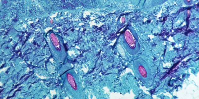 Part of the skin tissue taken from the skin lesions of monkeys infected with the monkeypox virus is seen at 50x magnification on the 4th day of the 1968 rash. 