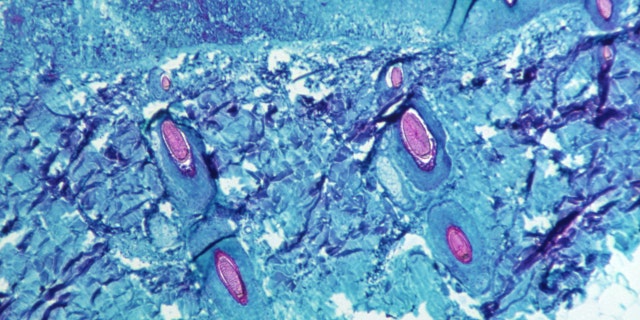 A section of skin tissue, harvested from a lesion on the skin of a monkey, that had been infected with monkeypox virus, is seen at 50X magnification on day four of rash development in 1968. 