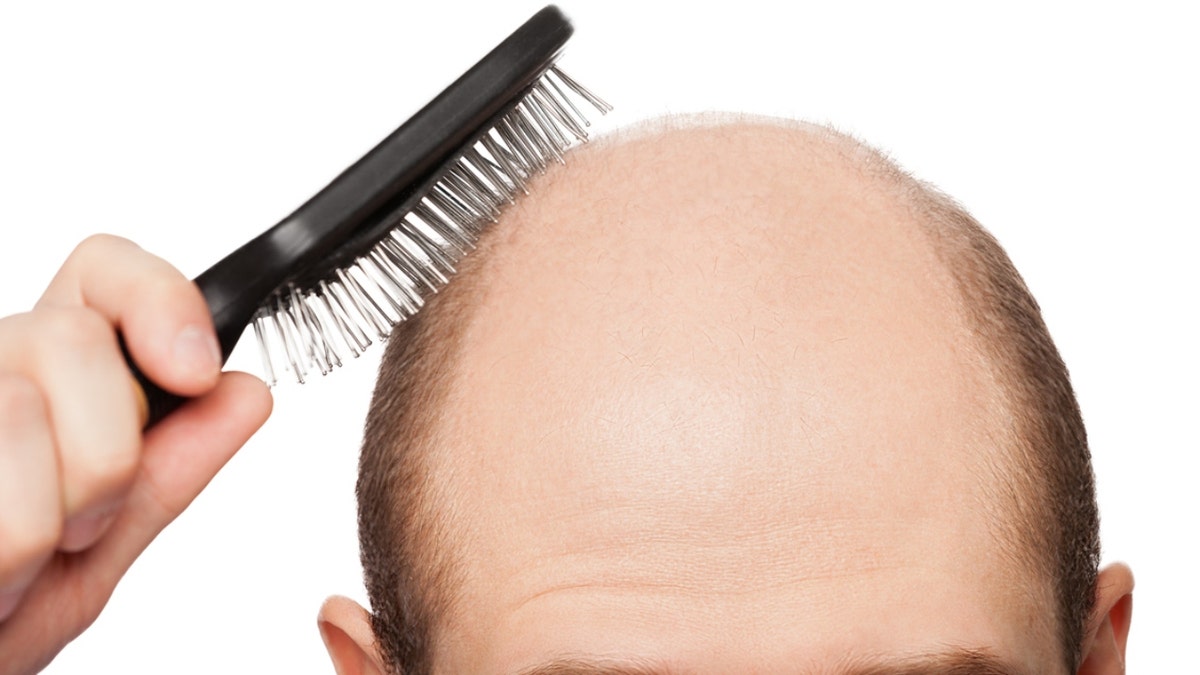 Man Alopecia