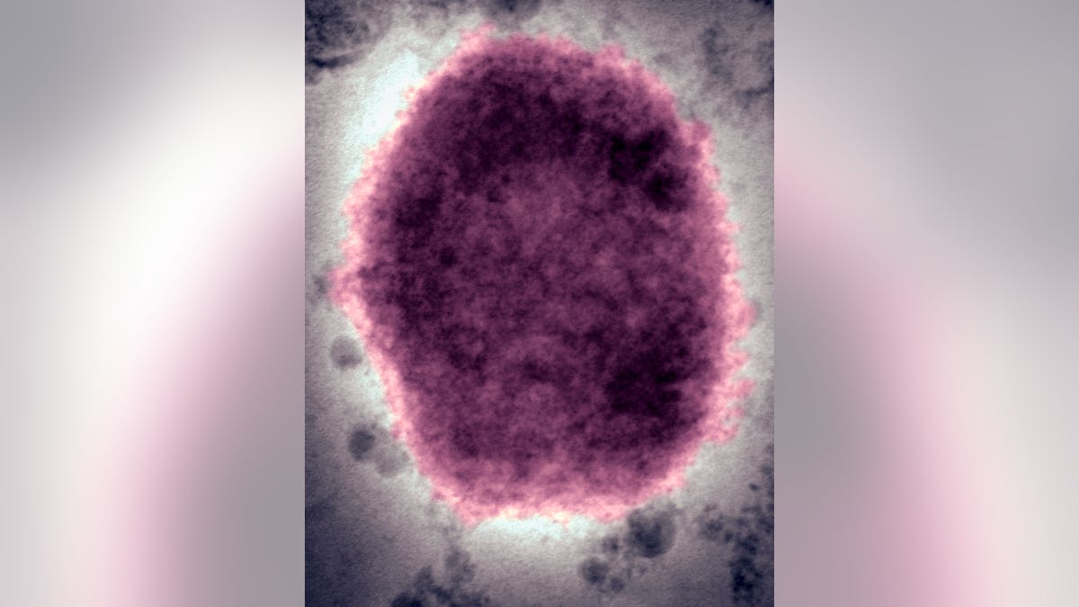 Monkeypox virus in human vesicular fluid