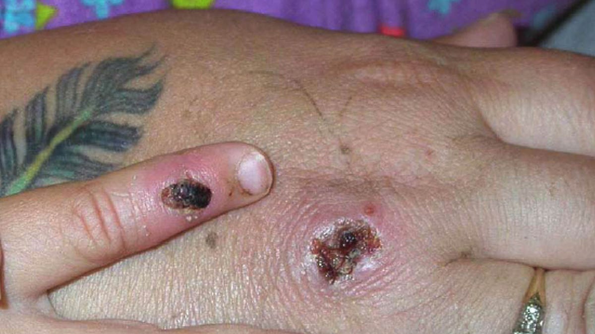 A picture of Monkeypox lesions on a woman's hand.