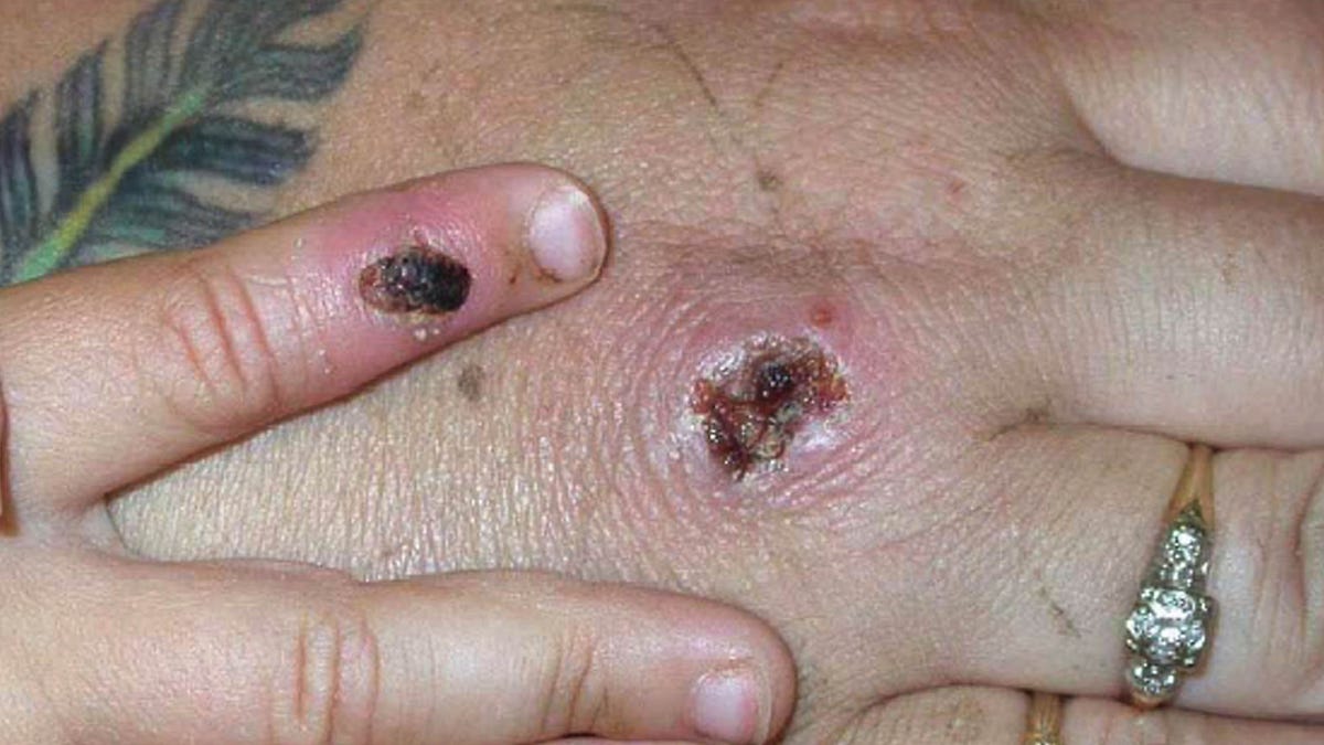 A picture of Monkeypox lesions on a woman's hand.