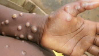 US officials find 2 monkeypox strains