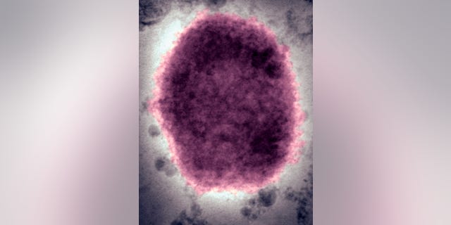 Monkeypox virus present In human vesicular fluid.