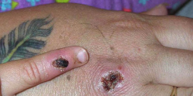In this graphic from the Centers for Disease Control and Prevention, symptoms of one of the earliest known cases of monkeypox virus are displayed on a patient's hand.