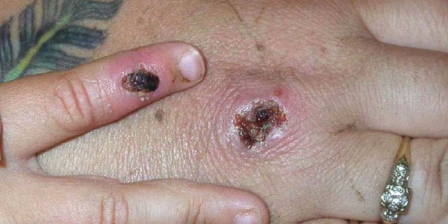 A Monkeypox lesion on a woman's hand. 