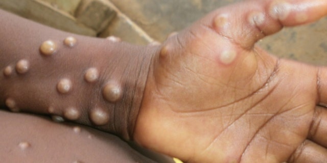Monkeypox in a Nigerian child