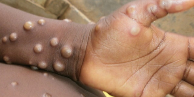 Monkeypox sur un enfant au Nigeria