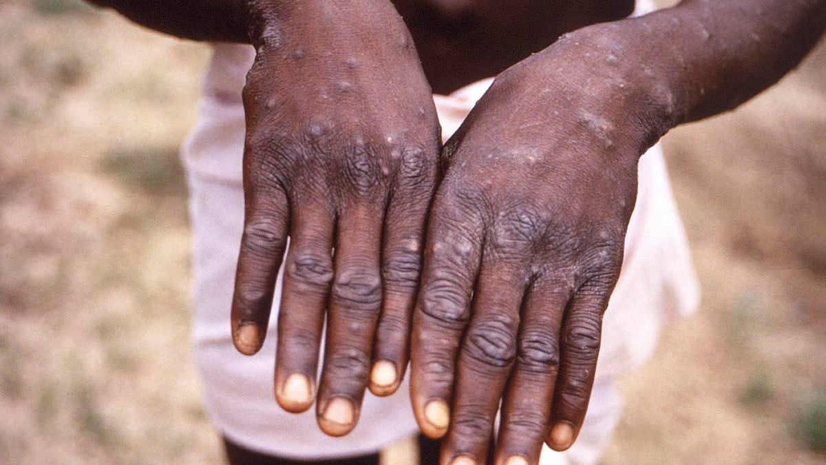 A monkeypox patient holds out their hands