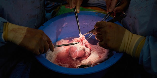 Surgeons prepare a genetically modified pig heart for transplant into a recently deceased donor at NYU Langone Health on July 6 in New York.