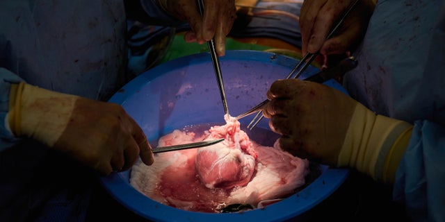 Surgeons prepare a genetically modified pig heart for transplant into a recently deceased donor at NYU Langone Health on July 6 in New York.