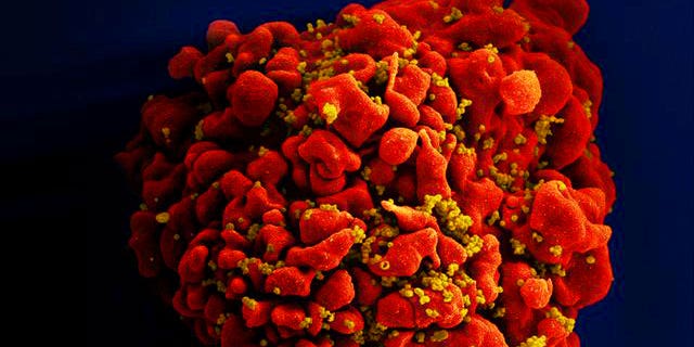 H9-T cell, red, infected with HIV particles, yellow.