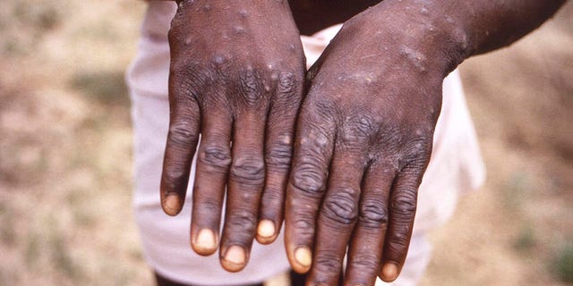 This 1997 image depicts the dorsal surfaces of the hands of a monkeypox case patient in Africa who was displaying the appearance of the characteristic rash during its recuperative stage. 