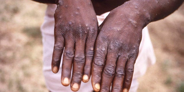 File-This 1997 image provided by the CDC during the investigation of the outbreak of monkeypox in the Democratic Republic of the Congo (DRC) (formerly Zaire) shows the back of the hands of monkeypox patients. During its recovery phase, it displayed a characteristic rash appearance. The World Health Organization will convene an emergency committee on Thursday, 21 July 2022 to consider a second time within a few weeks whether the outbreak of expanding monkeypox should be declared a global crisis.  (CDC via AP, file)